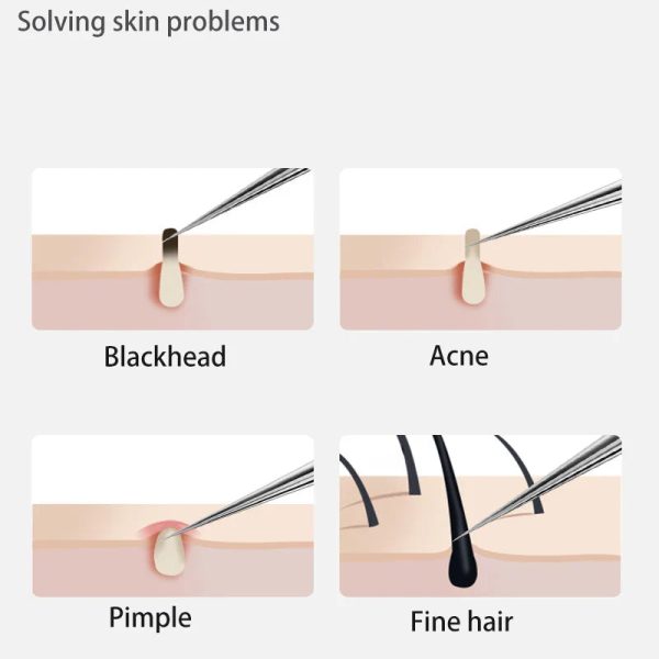 Acne Blackhead Removal Tool Acne Blackhead Removal Tool