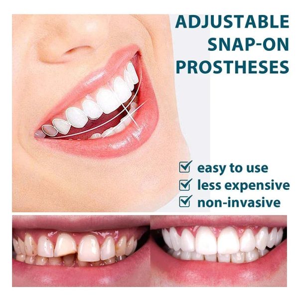 Adjustable Snap-On Dentures Adjustable Snap-On Dentures