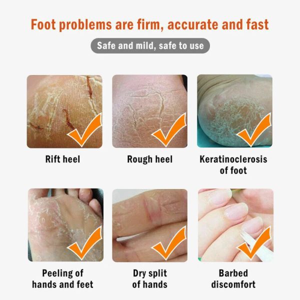 Dead Skin Remover Crack Cream Dead Skin Remover Crack Cream