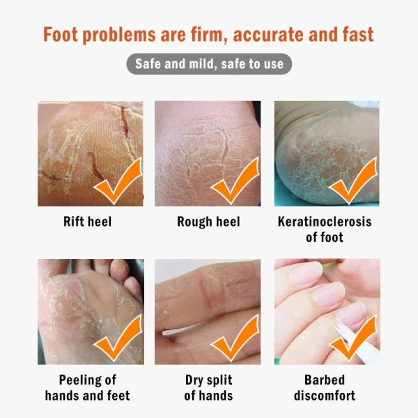 Dead Skin Remover Crack Cream Dead Skin Remover Crack Cream