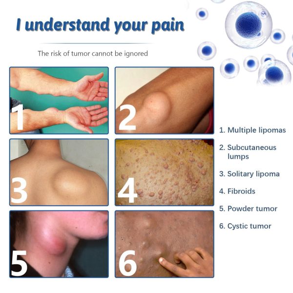 Lipoma Removal Spray Lipoma Removal Spray