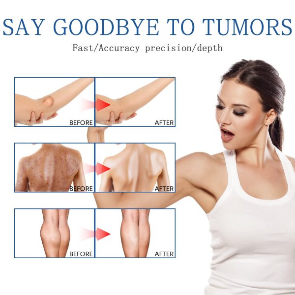 Lipoma Removal Spray Lipoma Removal Spray